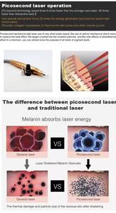 Máquina <span class=keywords><strong>de</strong></span> Eliminación <span class=keywords><strong>de</strong></span> Tatuajes con Láser <span class=keywords><strong>de</strong></span> Picosegundos Portátil a <span class=keywords><strong>Precio</strong></span> <span class=keywords><strong>de</strong></span> Mayoreo, Láser <span class=keywords><strong>de</strong></span> Picosegundos con Cabezales No Invasivos - Product Image 6