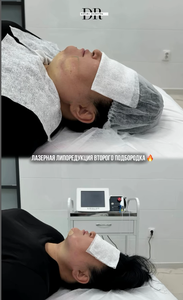 Machine laser professionnelle à double longueur d'onde 1470 nm 980 nm pour endolifting, prix pour l'élimination de la graisse et le raffermissement de la peau - Product Image 3