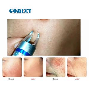 Peralatan Kecantikan Laser 15W 980Nm untuk Penghapusan Pembuluh Darah Merah dan Penghapusan Spider Veins di Wajah - Product Image 5