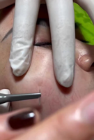 Appareil de suppression des varices et des vaisseaux sanguins à haute fréquence