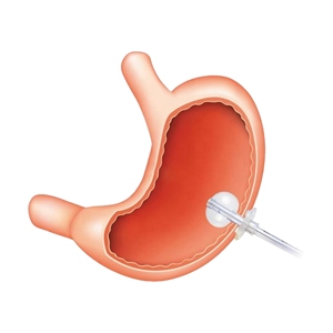 Y tế dùng một lần Silicone gastrostomy Ống Bộ dụng cụ cấu hình thấp gastrostomy ống cho nội soi PEG Bộ dụng cụ - Product Image 4