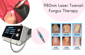 Máquina de Láser de Diodo de 980nm, Endoláser, Lipólisis, Tratamiento de Hongos en las Uñas, Fisioterapia, Eliminación Vascular, para Uso en Salones de Belleza - Product Image 4