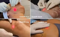 Aiguille émoussée de canule laser standard médical 60W 980nm 1470nm équipement de beauté de diode de levage Endo pour la liposuccion