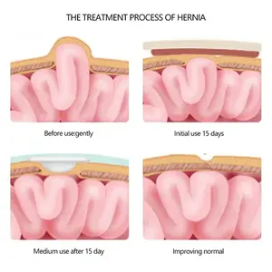 2 Buah Sabuk Terapi <span class=keywords><strong>Hernia</strong></span> Umbilikalis Bersertifikat CE Inframerah Jauh Tas Bernapas Tali Katun Elastis Bayi Usia 0-1 Tahun - Product Image 3