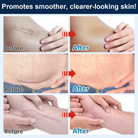 SEFUDUN 5 en 1 Baume cicatrisant pour la peau Produits de soin de la peau Baume efficace pour éliminer les cicatrices Crème pour les brûlures Kéloïdes Acné Vieilles cicatrices Réparation