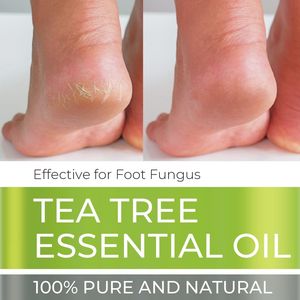 ETRUN ALISA Minyak Tea Tree Premium Label Pribadi Minyak Esensial Alami 100% Murni Alami Anti-Jamur Efektif untuk Jamur Kaki - Product Image 4