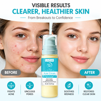 Crème anti-acné à marque privée, soin du visage pour peaux à tendance acnéique, contrôle du sébum, soulagement des rougeurs avec acide salicylique, vente en gros