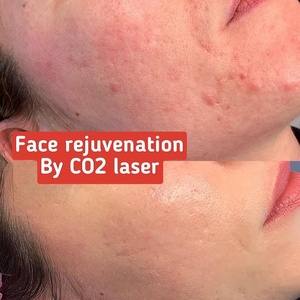 Mini xách tay fractional <span class=keywords><strong>CO2</strong></span> máy <span class=keywords><strong>laser</strong></span> 10600nm sẹo Ance loại bỏ vẻ đẹp máy <span class=keywords><strong>laser</strong></span> - Product Image 5