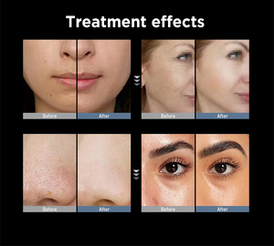 Máquina Facial de Microdermoabrasión Hydra System 7 en 1 ADSS con Hidropeel y Aqua Jet para Salón de Belleza - Product Image 6