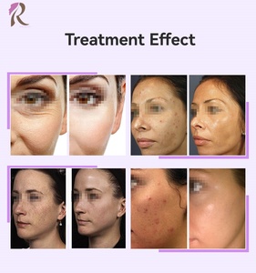 Dispositivo de Estimulación ATP de Alta Frecuencia, Fuertemente Recomendado, Potenciador de Colágeno para Reducción de Arrugas, Eliminación de Acné y Reafirmación de la Piel - Product Image 3