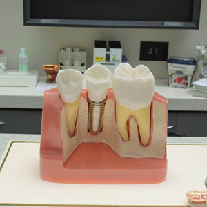 Modèle de <span class=keywords><strong>dent</strong></span> pour l'enseignement dentaire, modèle de caries dentaire, bon <span class=keywords><strong>prix</strong></span> - Product Image 3