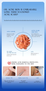 Acné soins de la peau visage peau acné boutons crème <span class=keywords><strong>Anti</strong></span>-acné crème points noirs pour les imperfections boutons huile Lotion formes pour usage domestique - Product Image 5