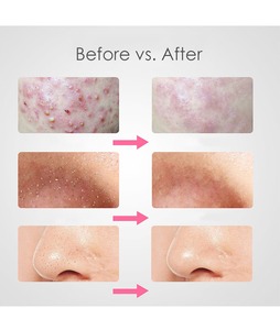 Estrattore di <span class=keywords><strong>Acne</strong></span> in oro rosa professionale in acciaio inossidabile per rimuovere l'<span class=keywords><strong>acne</strong></span> ago per punti neri 4 pezzi strumento di bellezza - Product Image 3