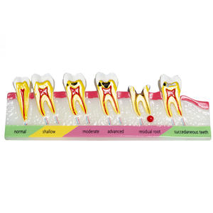 Modelo de Clasificación de Caries Dentales, Demostración de la Evolución de la Caries, Explicación de la Comunicación Médico-Paciente, Enseñanza Dental - Product Image 4