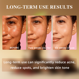 Sérum Visage <span class=keywords><strong>Anti</strong></span>-Imperfections Hydratant Éclaircissant à la Niacinamide, Alpha Arbutine et Vitamine C, Correcteur de Pigmentation et <span class=keywords><strong>Anti</strong></span>-Acné, Marque Blanche - Product Image 2