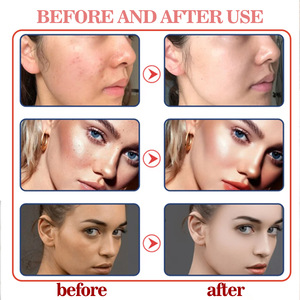 Limpiador facial al por mayor de fábrica, limpiador profundo antiacné con control de grasa y ácido kójico - Product Image 3