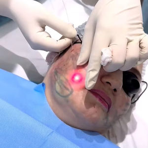 Липолиз, липолиз, 47 Вт, 980 нм, 1470 нм - Product Image 4