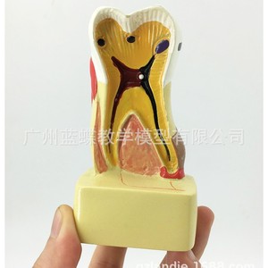 Modelo de caries dental; modelo patológico completo de enfermedades dentales; modelo anatómico seccional del diente; dientes; - Product Image 5