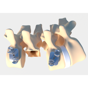 Combinación de Rejilla <span class=keywords><strong>Fata</strong></span> de Titanio de Alta Calidad para Cirugía de Columna Vertebral, Órganos Artificiales Implantables a Precio Competitivo - Product Image 3