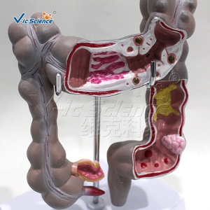 Modelo Patológico <span class=keywords><strong>de</strong></span> Intestino Grueso: Tuberculosis, Enfermedad <span class=keywords><strong>de</strong></span> Crohn, Colitis Ulcerativa, Inflamación - Product Image 3