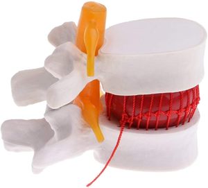 인체 요추 1.5배 확대 척추 의학 교육용 뼈 모형 (인체 요추 디스크 돌출) 의료 학생 실습 교육용 - Product Image 2