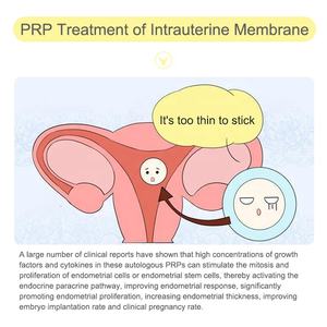 พลาสม่าที่อุดมไปด้วยเกล็ดเลือดทางการแพทย์สำหรับเยื่อบุโพรงมดลูกอักเสบ - Product Image 2