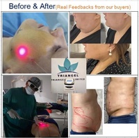 Triangelmed la plupart se vendent bien Endolaser lifting du visage enlèvement de graisse fibre 980nm Diode Laser lipolyse Machine