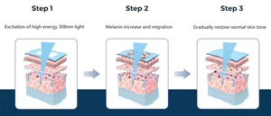 2025 modelo más nuevo médico Real 308nm Xecl Excimer equipo láser Led filtros especiales tratar <span class=keywords><strong>eczema</strong></span> vitiligo enfermedades de la <span class=keywords><strong>piel</strong></span> - Product Image 2