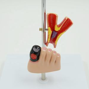 Model Anatomi Kaki Diabetik Ilmu Kedokteran Menunjukkan Pola <span class=keywords><strong>Diabetes</strong></span> Termasuk Pola Organ Patologis - Product Image 2