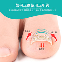 Correcteur d'ongles incarnés, attelle de correction pour ongles incarnés, clip de redressement d'ongles, patch de récupération