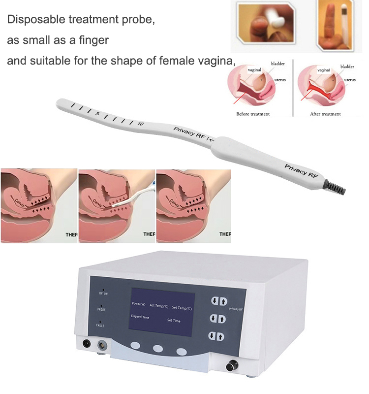 Disposable treatment probe for the Thermiva RF Vagina Tightening Machine.