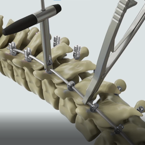 Hoogwaardige titanium implanteerbare kunstorganen COX II voor wervelkolomchirurgie, medisch hulpmiddel klasse III - Product Image 4