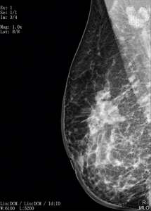 Detektor Panel Datar CsI TI Nirkabel IRay Mammo 1012C 10*12 inci untuk Mesin Mamografi <span class=keywords><strong>Digital</strong></span> MSLFP30 - Product Image 6