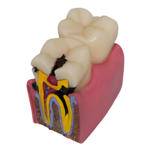 Modello Comparativo di Denti con 6 Volte Più Danni, Modello di Denti in Resina Dentale Smontabile - Product Image 1