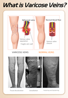 Collants de compression médicaux tricotés opaques antibactériens 20-30 mmHg pour femmes, à bout fermé, respirants, pour varices