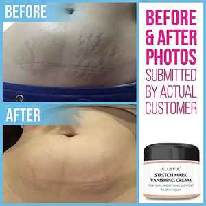 Crema elástica para eliminar cicatrices, crema para eliminar cicatrices, tratamiento de maternidad - Product Image 3