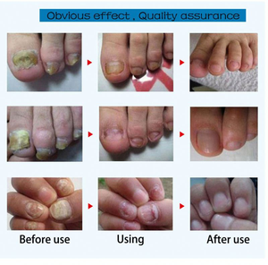 Lápiz Reparador de Uñas, Tratamiento para Onicomicosis, Desinfectante, Protege las Uñas, Gel Efectivo para la Paroniquia e Infecciones por Hongos - Product Image 2