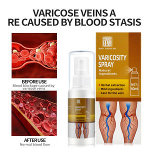 Pasokan Perawatan Kesehatan Lintas Batas untuk Meredakan Varises dari Pembuluh Darah yang Menonjol, Nyeri, Mati Rasa, dan Pembengkakan di Kaki - Product Image 3