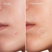 Patch anti-acné hydrocolloïde absorbant, gel hydrophile, hypoallergénique, à la niacinamide, pour tous types de peaux