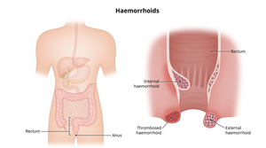 Máquina Láser de Diodo Portátil para Proctología 980nm 1470nm para Cirugía de Fístulas Anales, Hemorroides y Pilas, Fibra Cónica de Urología Alemana - Product Image 3