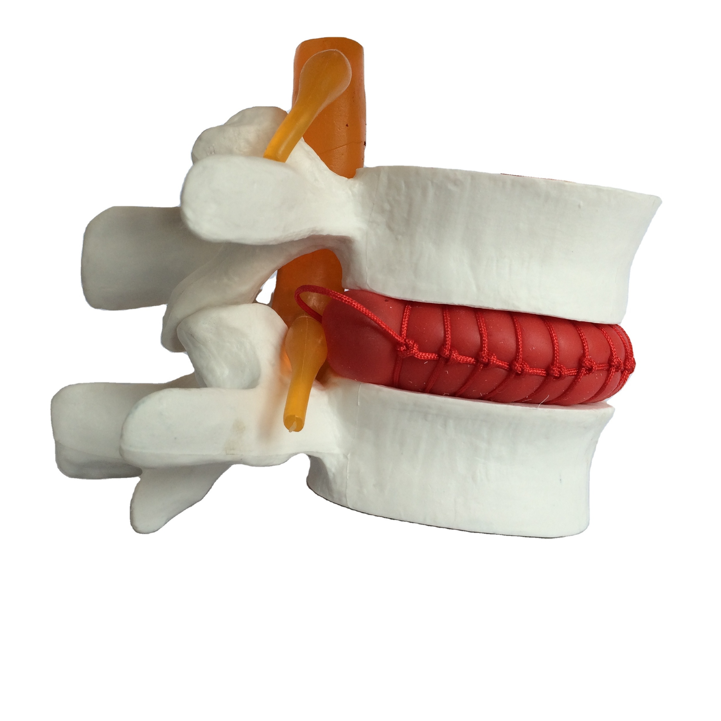 Поясничная позвоночника с выпадение 2 раза увеличенные анатомическая модель