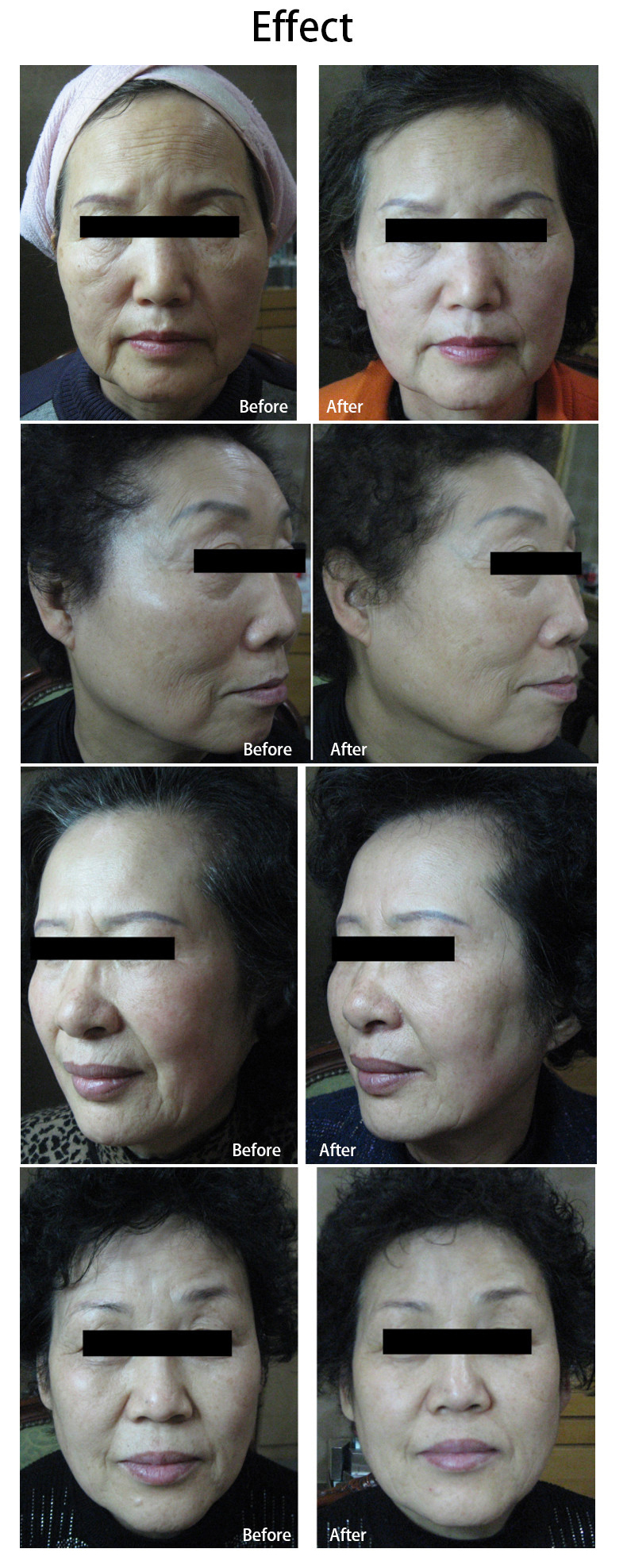 7D Hifu Vertical Beauty High-Intensity Fokuseret ultralyd Ultra 7D Mage Hifu Hifu 7D Maskine