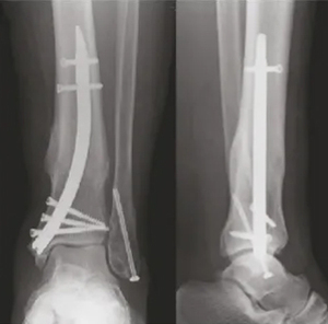Clou Tibial Distal DTN avec Embout de 0 mm, Dispositif Médical Implantable CE ISO pour Distributeurs Orthopédiques - Product Image 2