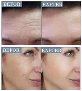 Set <span class=keywords><strong>de</strong></span> sérum <span class=keywords><strong>de</strong></span> visage or pour la gestion <span class=keywords><strong>de</strong></span> la peau, élimination des <span class=keywords><strong>rides</strong></span>, sans aiguille, lifting, protéine, fil <span class=keywords><strong>de</strong></span> remplissage, sculpture - Product Image 6