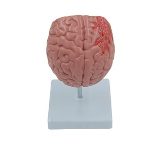 Modèle de <span class=keywords><strong>pathologie</strong></span> du cerveau humain avec hémorragie et malformation <span class=keywords><strong>vasculaire</strong></span> pour l'enseignement de l'anatomie - Product Image 2