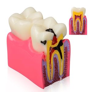 Modèle de démonstration de caries dentaires, modèle d'enseignement de l'anatomie dentaire pour l'éducation et l'explication aux patients - Product Image 1