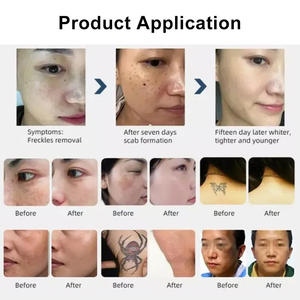Pico 1064 532 1320 nm Tattoo Eyebrow Scar care Pigmentation Cleaner Skincare Facial Homeuse Personal Care Machine - Product Image 4