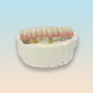 Pont Implantable Premium |   Base en titane avec couronne en céramique pour une restauration dentaire fiable | pour laboratoire ou clinique - Product Image 1