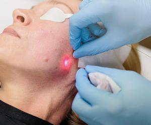 Fibre Endolaser Médicale CE SMA905 1470nm pour Lifting Facial Laser, Fibre ENT <span class=keywords><strong>Bara</strong></span>, Fibre Radiale EVLT EVLA - Product Image 6