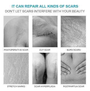 Crème efficace <span class=keywords><strong>pour</strong></span> éliminer <span class=keywords><strong>les</strong></span> cicatrices de <span class=keywords><strong>vergetures</strong></span> de grossesse et gel cicatriciel <span class=keywords><strong>pommade</strong></span> à base de plantes <span class=keywords><strong>pour</strong></span> <span class=keywords><strong>enlever</strong></span> <span class=keywords><strong>les</strong></span> cicatrices des brûlures - Product Image 3